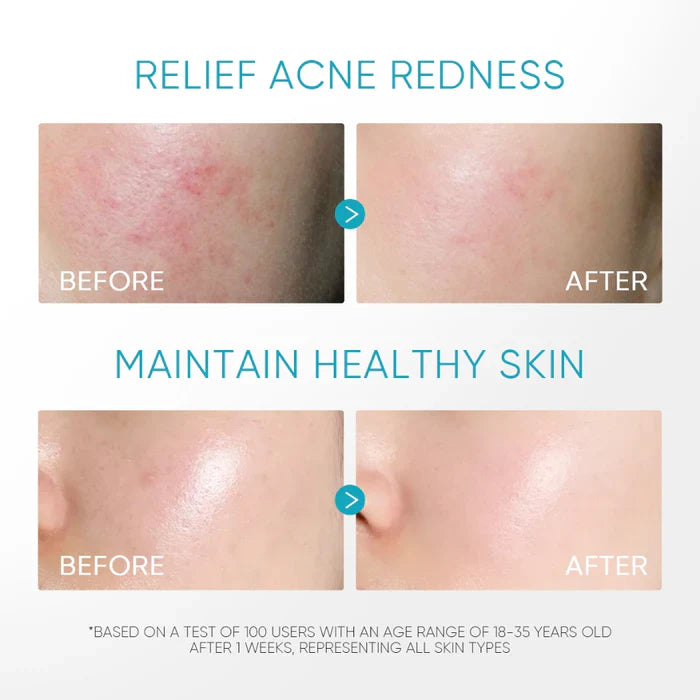 Panthenol Acne Gel Moisturizer