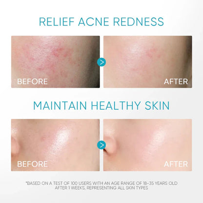 Panthenol Acne Gel Moisturizer